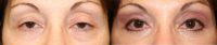 Age-related droopy upper eyelids/ptosis in late 50s female
