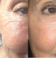 Woman treated with Fraxel Laser