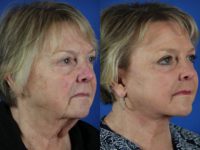 66 year old woman treated with Facelift, Upper and Lower Blepharoplasty, and Laser Skin Resurfacing