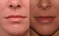 35 year old woman treated with Juvederm for modest lip augmentation