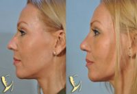 35-44 year old woman treated with Nose Surgery