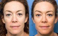 52 year old woman treated with Laser Resurfacing