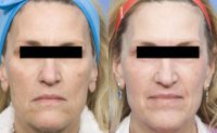 56 year old woman treated with Laser Resurfacing