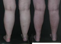 45-54 year old woman treated with Liposculpture