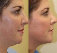 Woman treated with Injectable Fillers