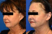 55-64 year old woman treated with Facelift, Pixie Ear Correction