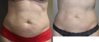 45-54 year old woman treated with SculpSure