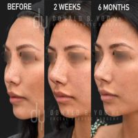 Asian Rhinoplasty with rib cartilage and DCF (diced cartilage fascia)