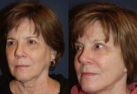 Female with Facelift and Chin Implant