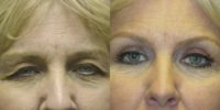 62 years old female with droopy eyelids.