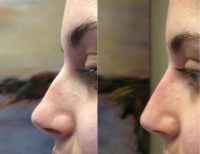 Before & After Restylane for nonsurgical nose job/rhinoplasty