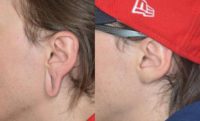 18-24 year old man treated with Earlobe Surgery