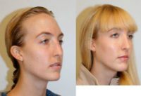 Woman treated with Facial Fat Transfer