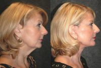 45-54 year old woman treated with Deep Plane Facelift