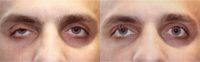 42 year old man treated with Ptosis Surgery