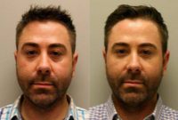 Man in his 30s treated with Injectable Fillers