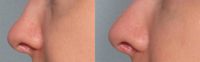 Juvederm in the nose