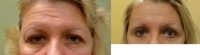 55-64 year old woman treated with Eyelid Surgery and Brow Lift