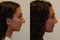 19 year old woman treated with Rhinoplasty - 6 months after surgery