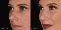 Rhinoplasty Before & After 2 Weeks, Performed by Dr. Kian Karimi at Rejuva Medical Aesthetics