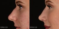Rhinoplasty Before & After 2 Weeks, Performed by Dr. Kian Karimi at Rejuva Medical Aesthetics