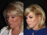 45-54 year old woman treated with Facelift, Neck Lift