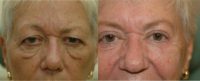 55-64 year old man treated with Eye Bags Treatment