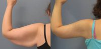 25-34 year old woman treated with Arm Lift