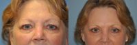 Eyelid surgery in middle aged woman