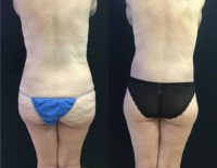 45-54 year old woman treated with Arm Lift, Body Lift, and Breast Augmentation with Lift