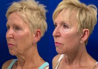 62 year old woman treated with Neck Lift