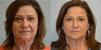 55-64 year old woman treated with Lower Eyelid Surgery