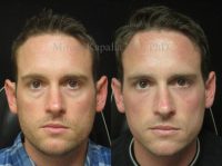 Man treated with Eye Bags Treatment