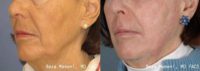 65-74 year old woman treated with Skin Rejuvenation