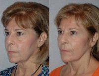Facelift, Upper Eyelid Lift, Facial Fat Transfer
