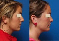 Rhinoplasty (Nose Reshaping)