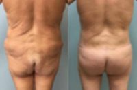 45-54 year old woman treated with Brazilian Butt Lift and Skin Tightening/Repositioning