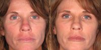 Cheek Augmentation with fillers