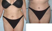 35-44 year old woman treated with Laser Liposuction