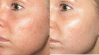 25-34 year old woman treated with Skin Rejuvenation