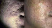 25-34 year old man treated with Acne Scars Treatment