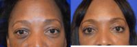 Upper & Lower Eyelid Surgery Before & After