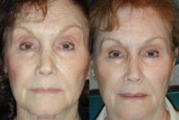 55-64 year old woman treated with Non Surgical Nose Job