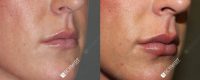 Woman treated with Juvederm