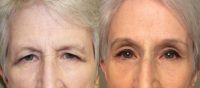 65-74 year old woman treated with Brow Lift and upper lid blepharoplasty, no lower lid work was done