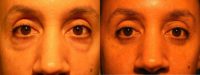 35-44 year old man treated with Eye Bags Treatment