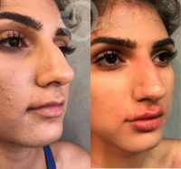 Woman treated with Nonsurgical Nose Job