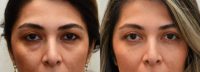 35-44 year old woman treated with Eye Bags