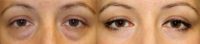 Transconjunctival blepharoplasty in young woman