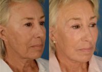 65-74 year old woman treated with Perioral and Lower Eyelid CO2 Laser resurfacing